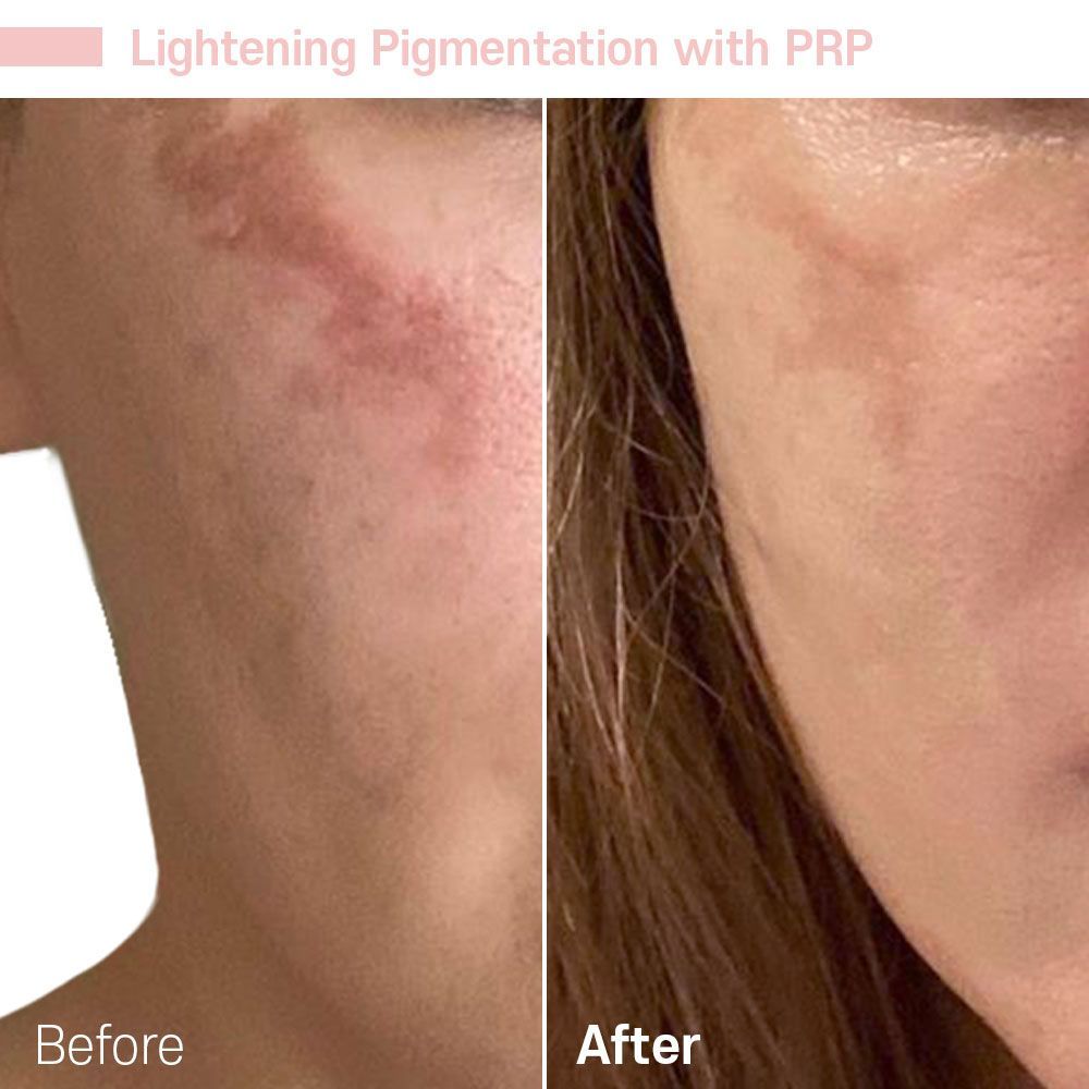 A before and after photo of a woman 's face with lightening pigmentation with prp.