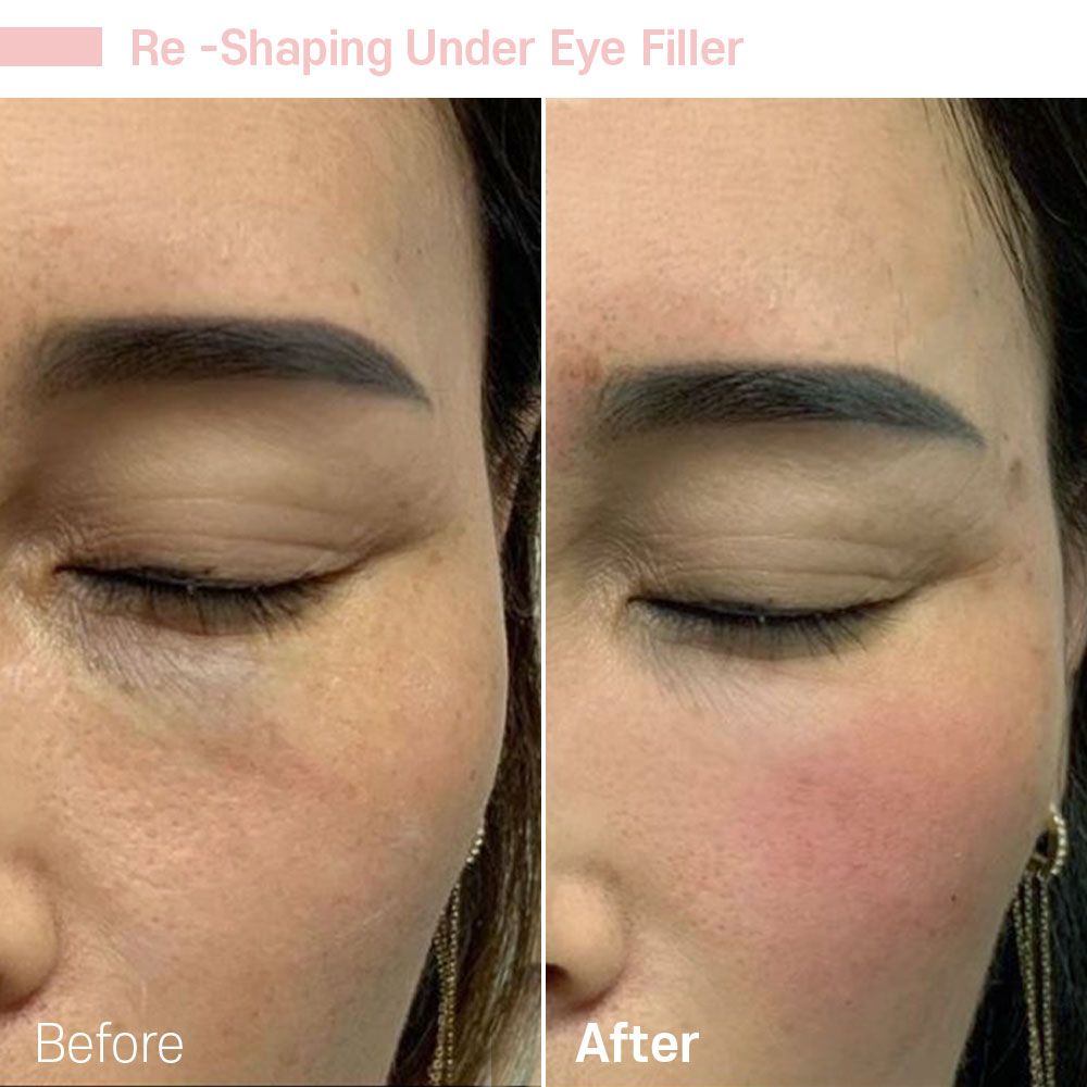 A before and after photo of a woman 's face with eye filler.
