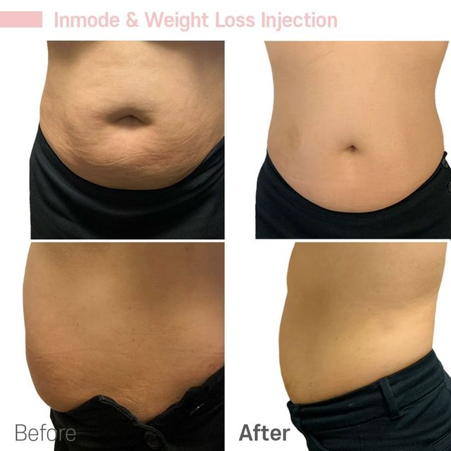 Skin Tightening Treatments To Target Loose Skin After Weight Loss -  Radiance Skincare & Laser Medspa