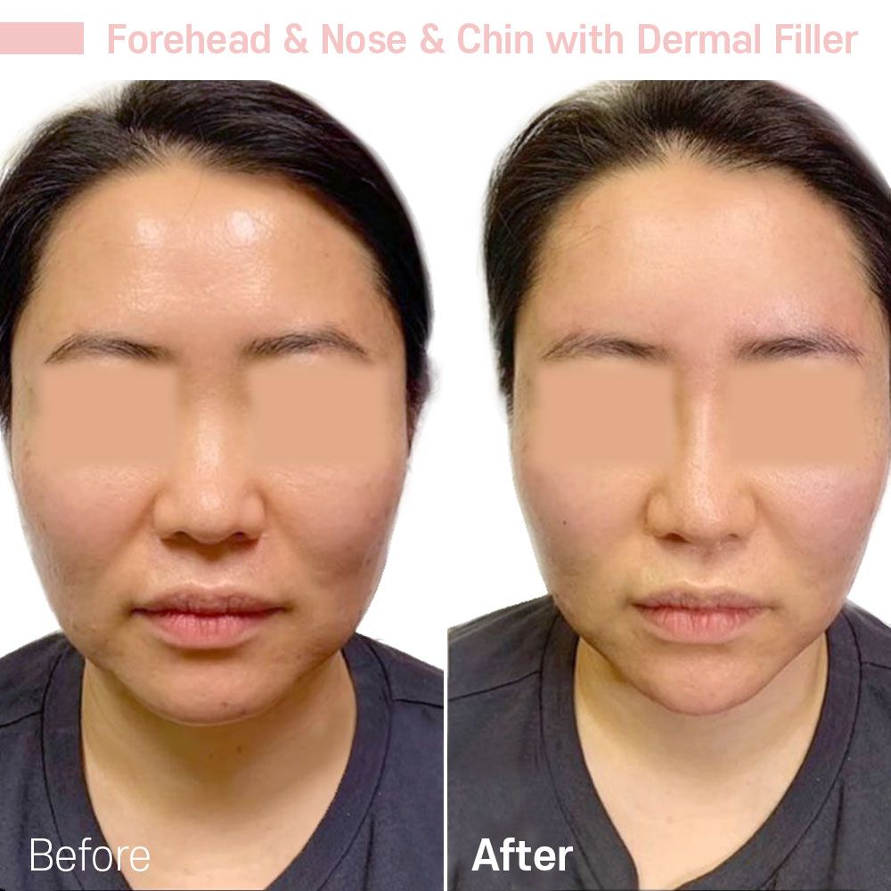 A before and after photo of a woman 's face with a dermal filler.