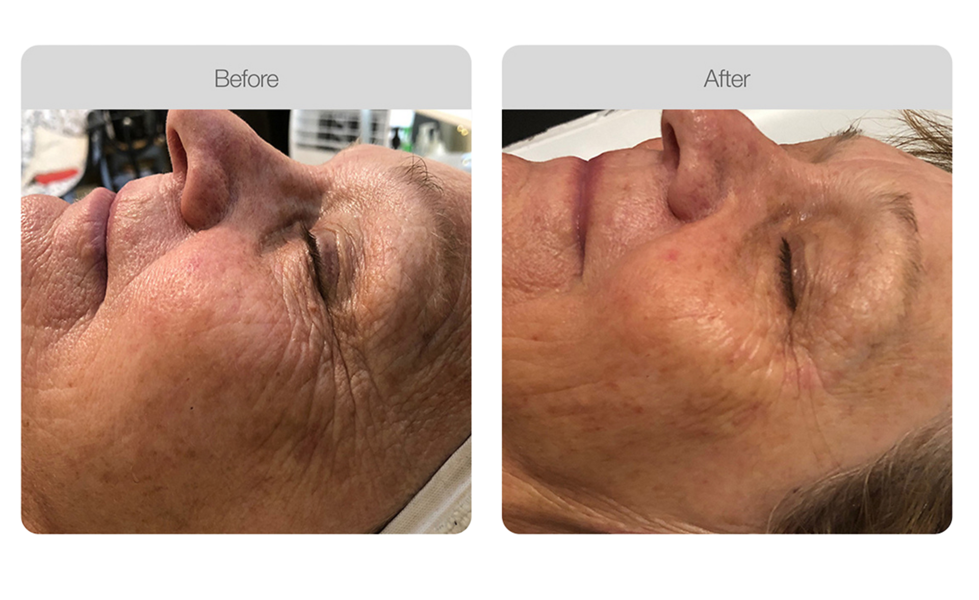 Closeup Portrait of Lovely Redheaded Woman with Closed Eyes Getting Oxygen Therapy in A Beauty Salon — Bersantai Medispa in Toukley, NSW