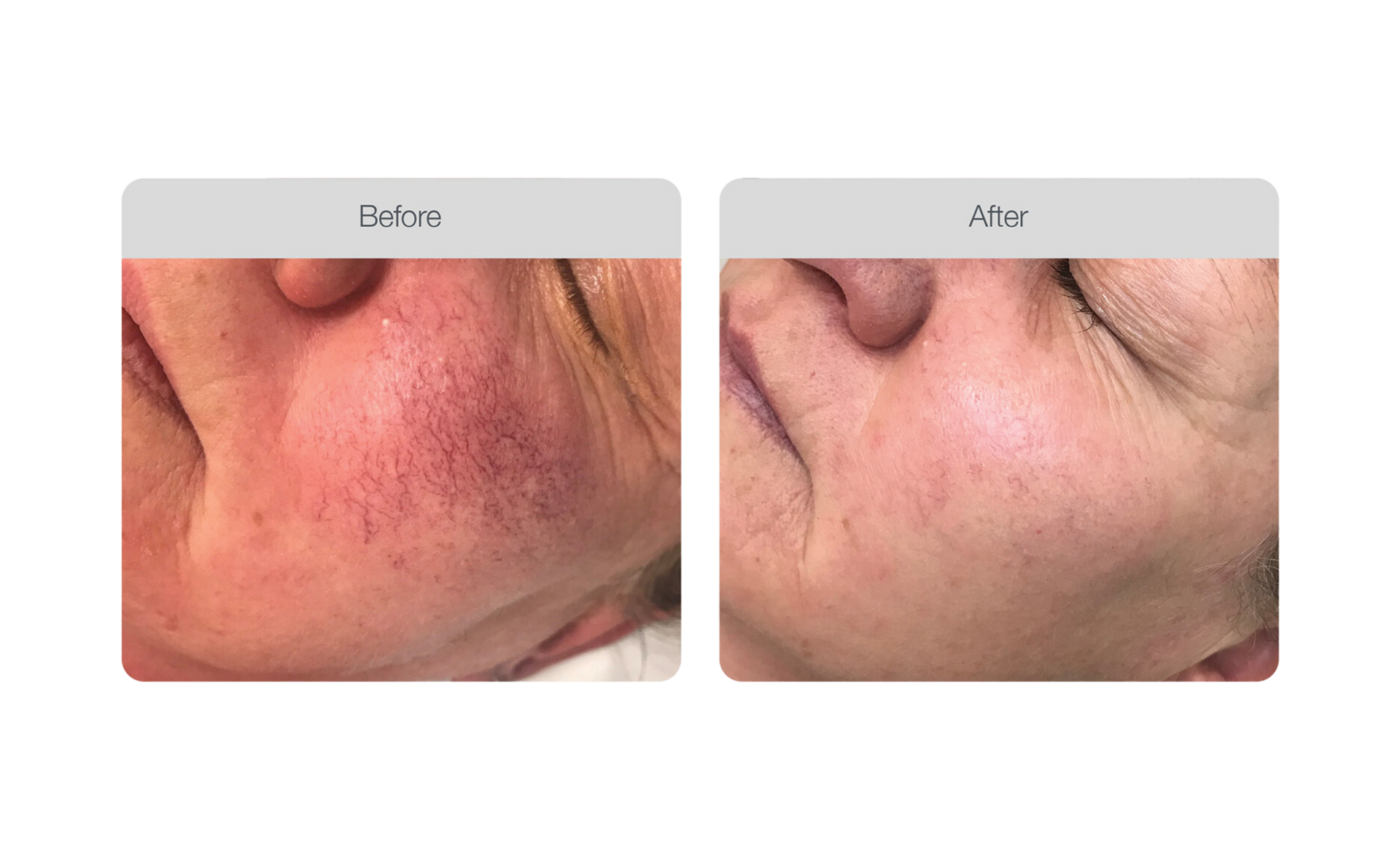 Removal of Rosacea or Vascular Mesh on the Patient's Legs with a Neodymium Laser — Bersantai Medispa in Toukley, NSW