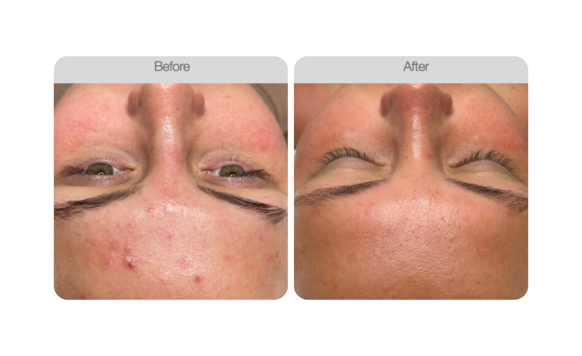 Young Woman Receiving Facial Beauty Treatment — Bersantai Medispa in Toukley, NSW