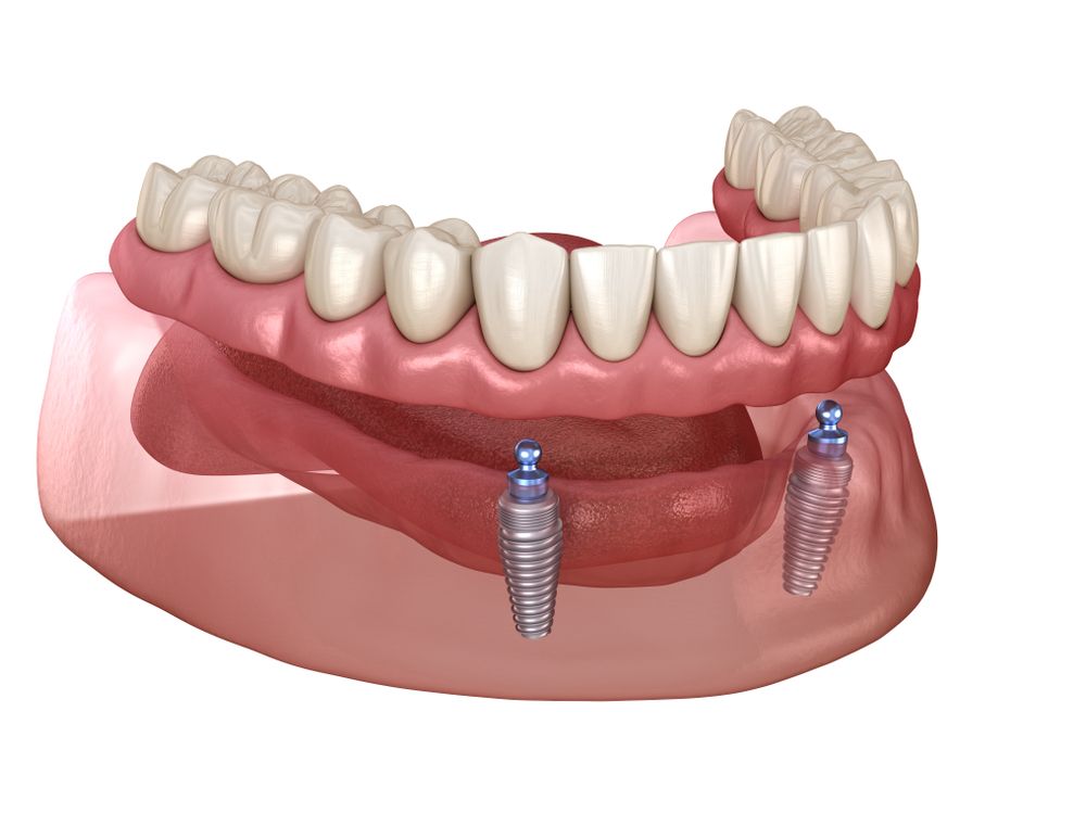 An illustration of all on 4 dental implants like those placed by Dr. Bean