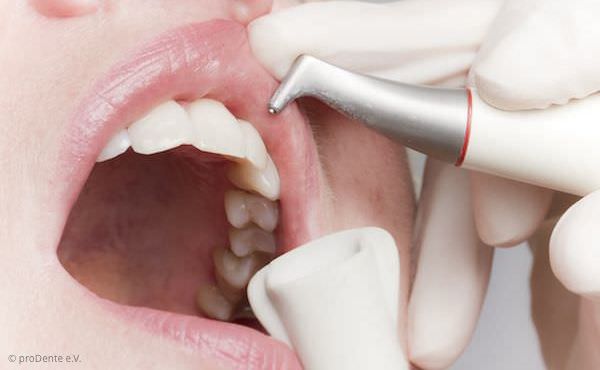 Zahnreinigung mit Pulverstrahlgerät