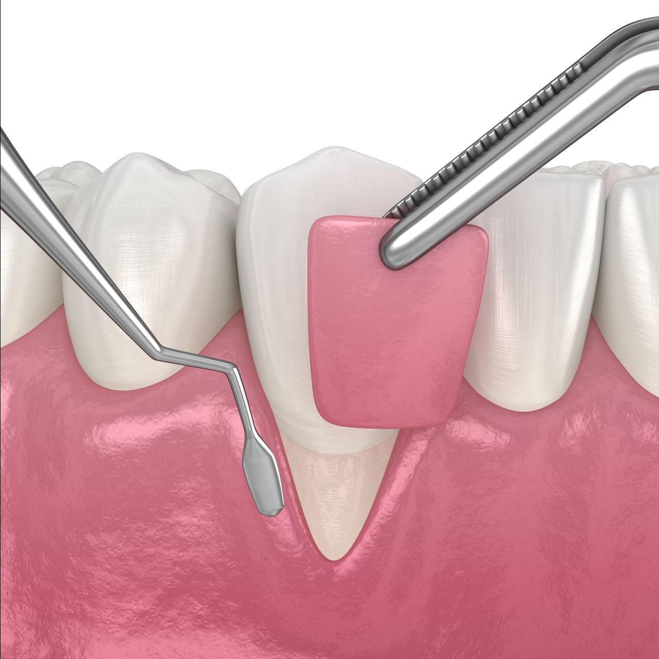 gum disease therapy from our restorative dentist in Corpus Christi tx 78404