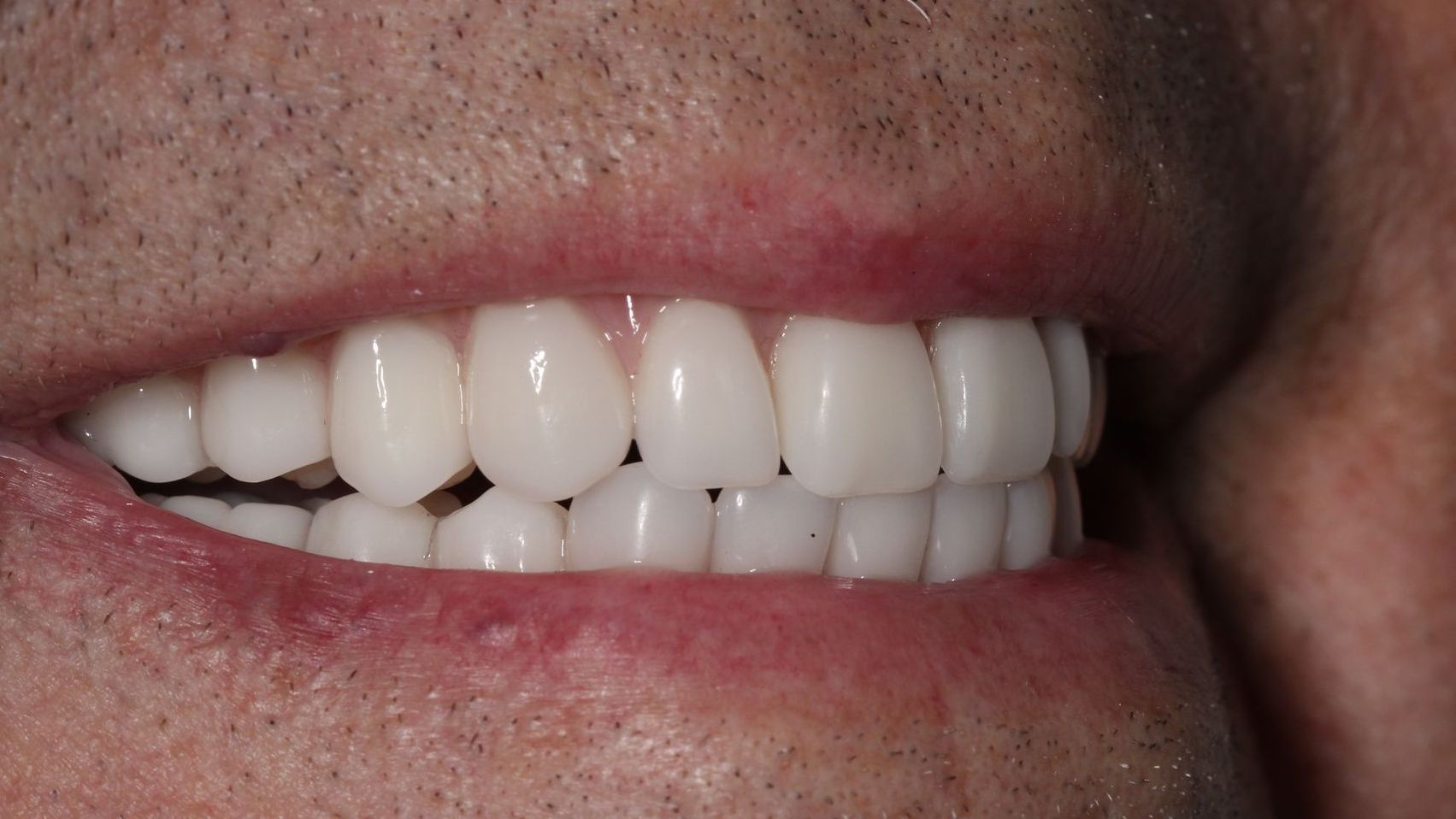 After Full Mouth Implants