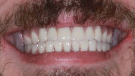 After Full Mouth Implants