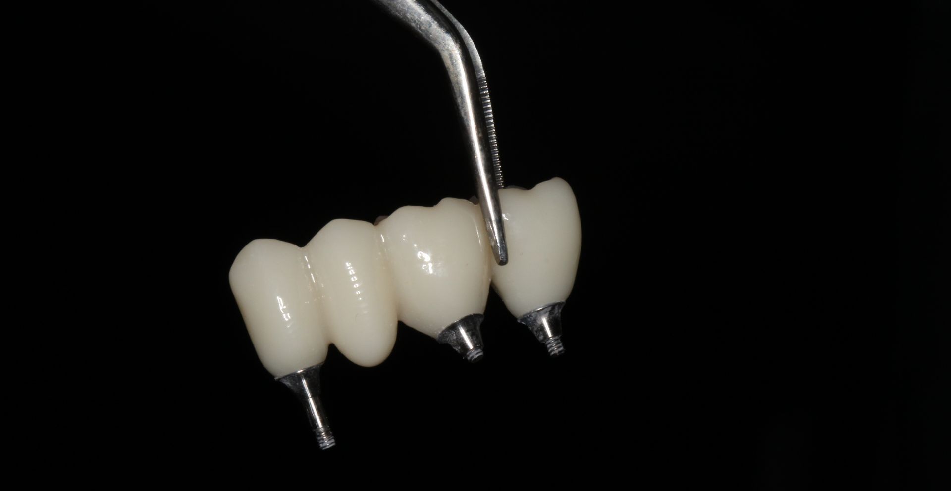 Implant-supported dental bridges