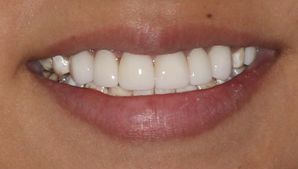 After Dental Veneers