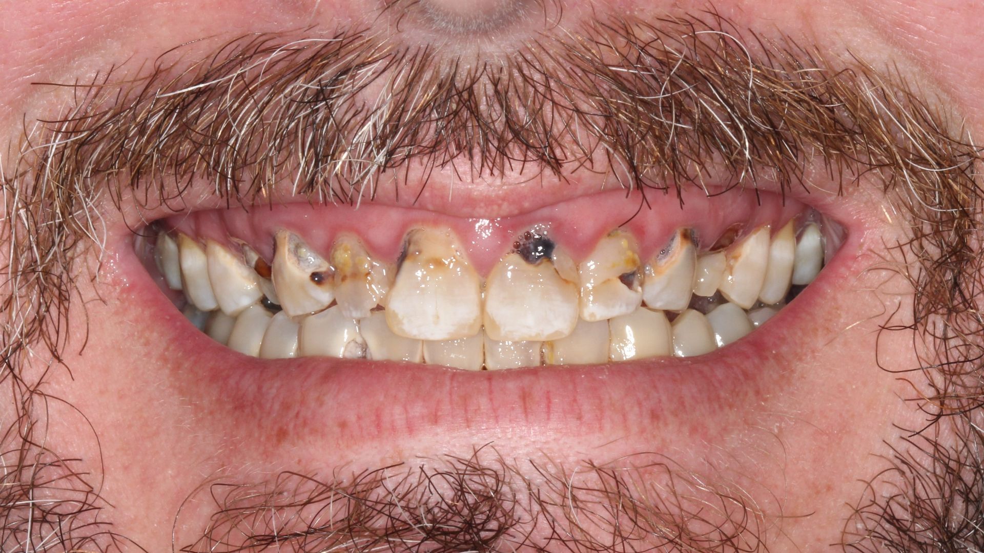 Before Full Mouth Implants