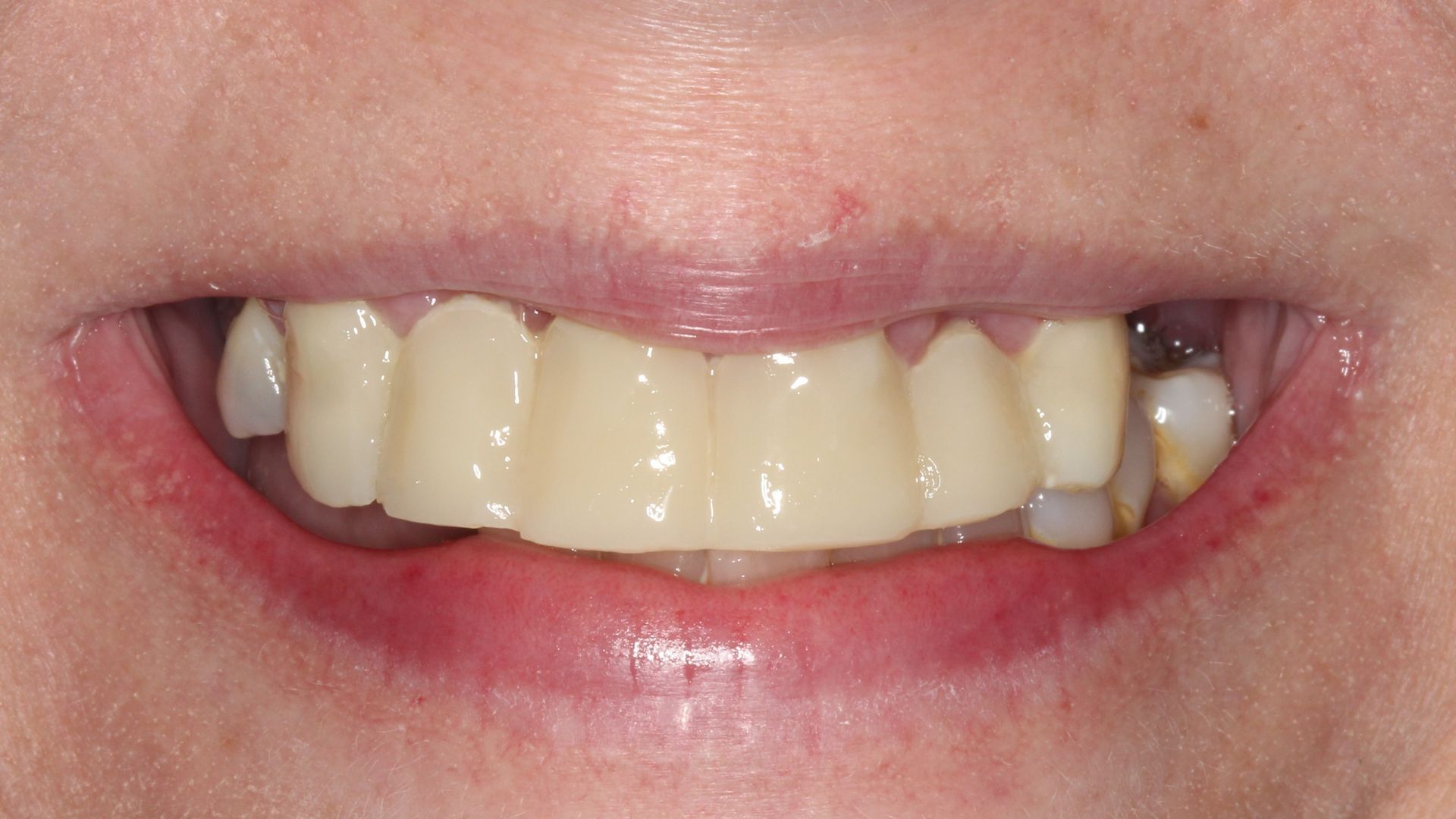 Before Full Mouth Implants