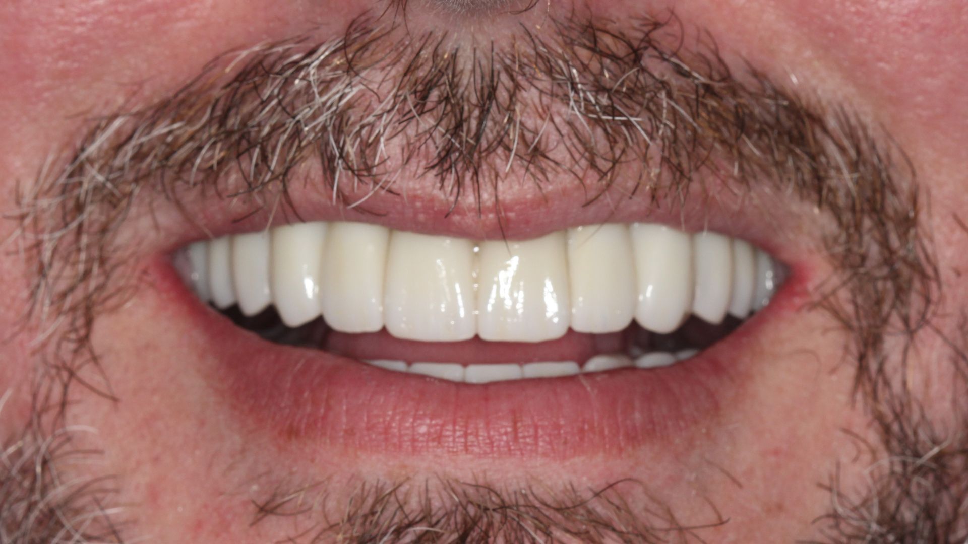 After Full Mouth Implants