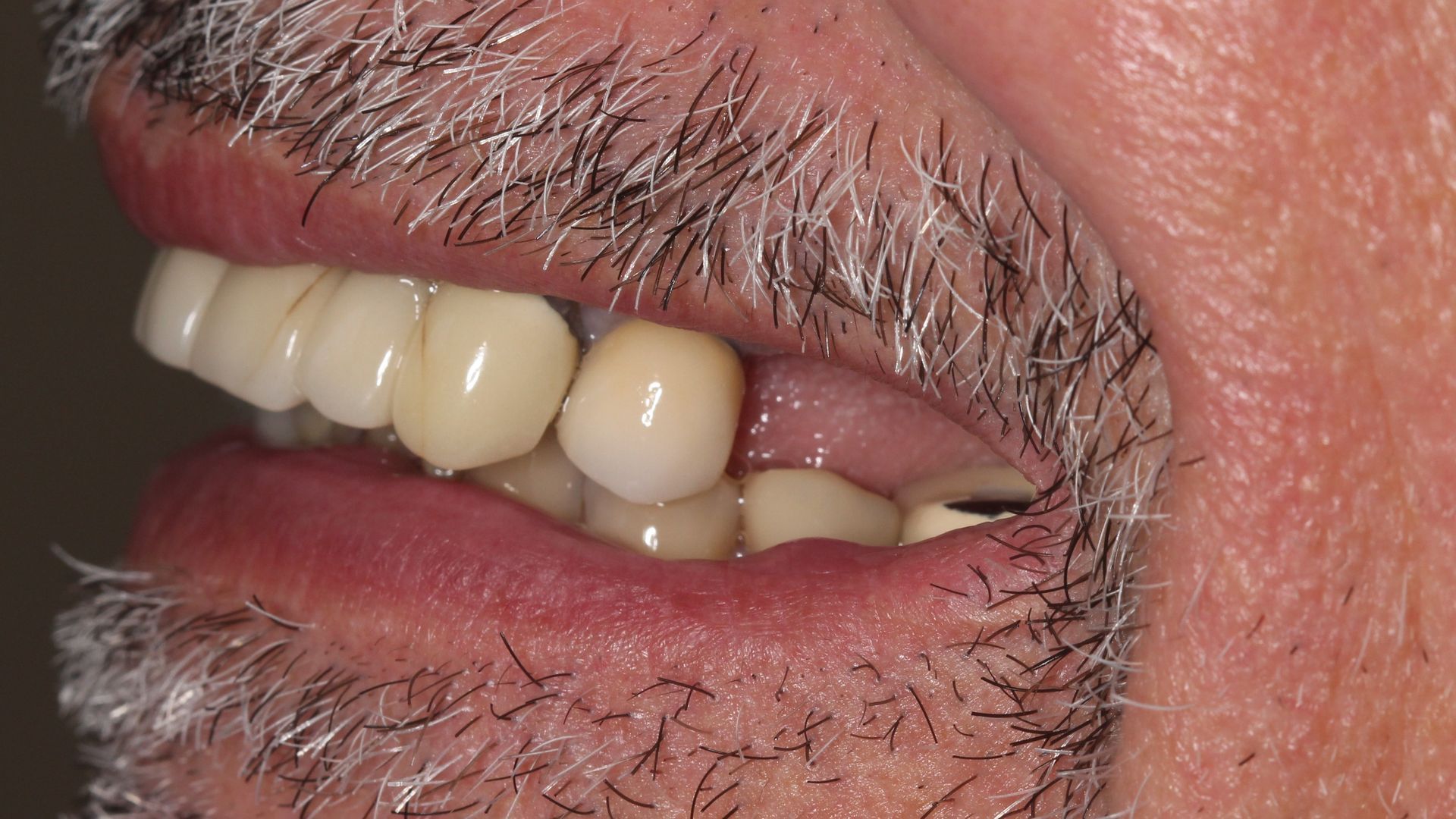 Before Full Mouth Implants