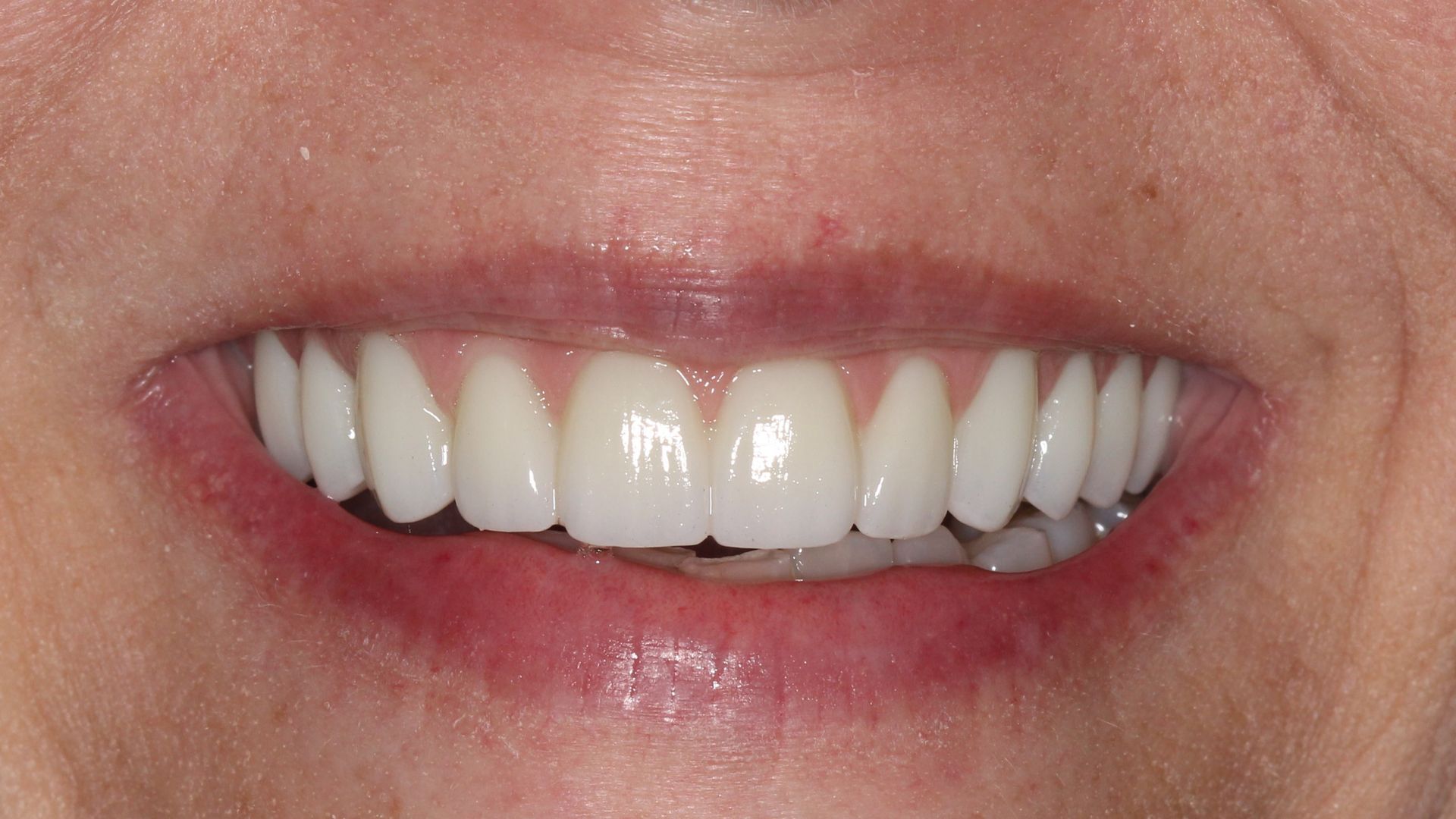 After Full Mouth Implants