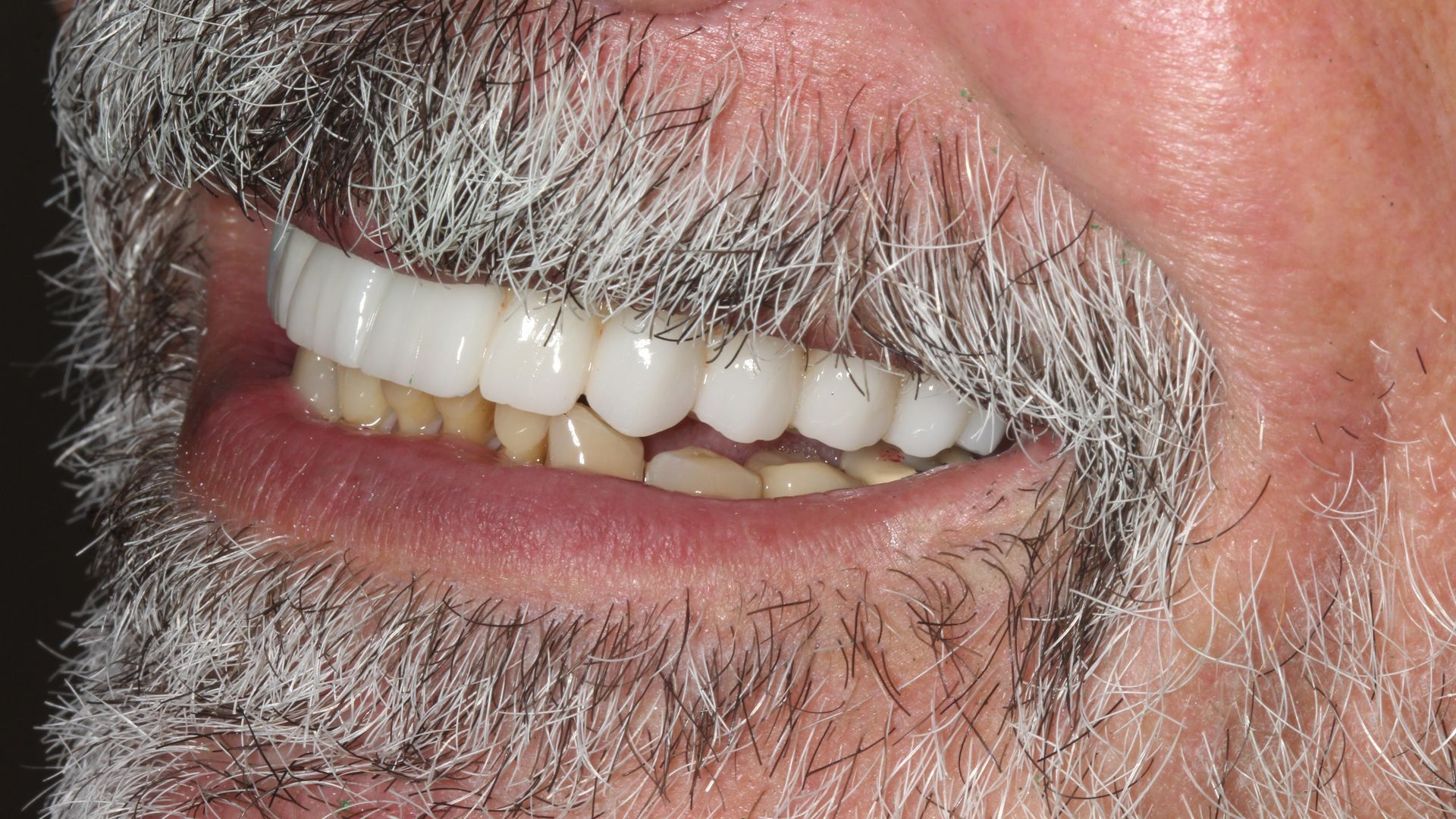 After Full Mouth Implants