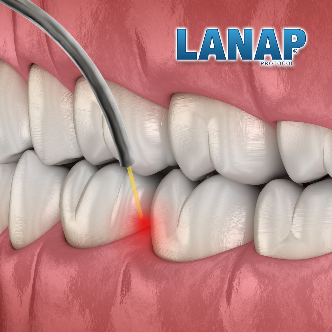 LANAP process image | Cosmetic dentist Corpus Christi tx 78404