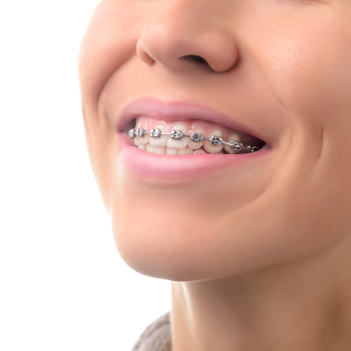 woman smiling with braces on | gum disease dentist in Corpus Christi 78404