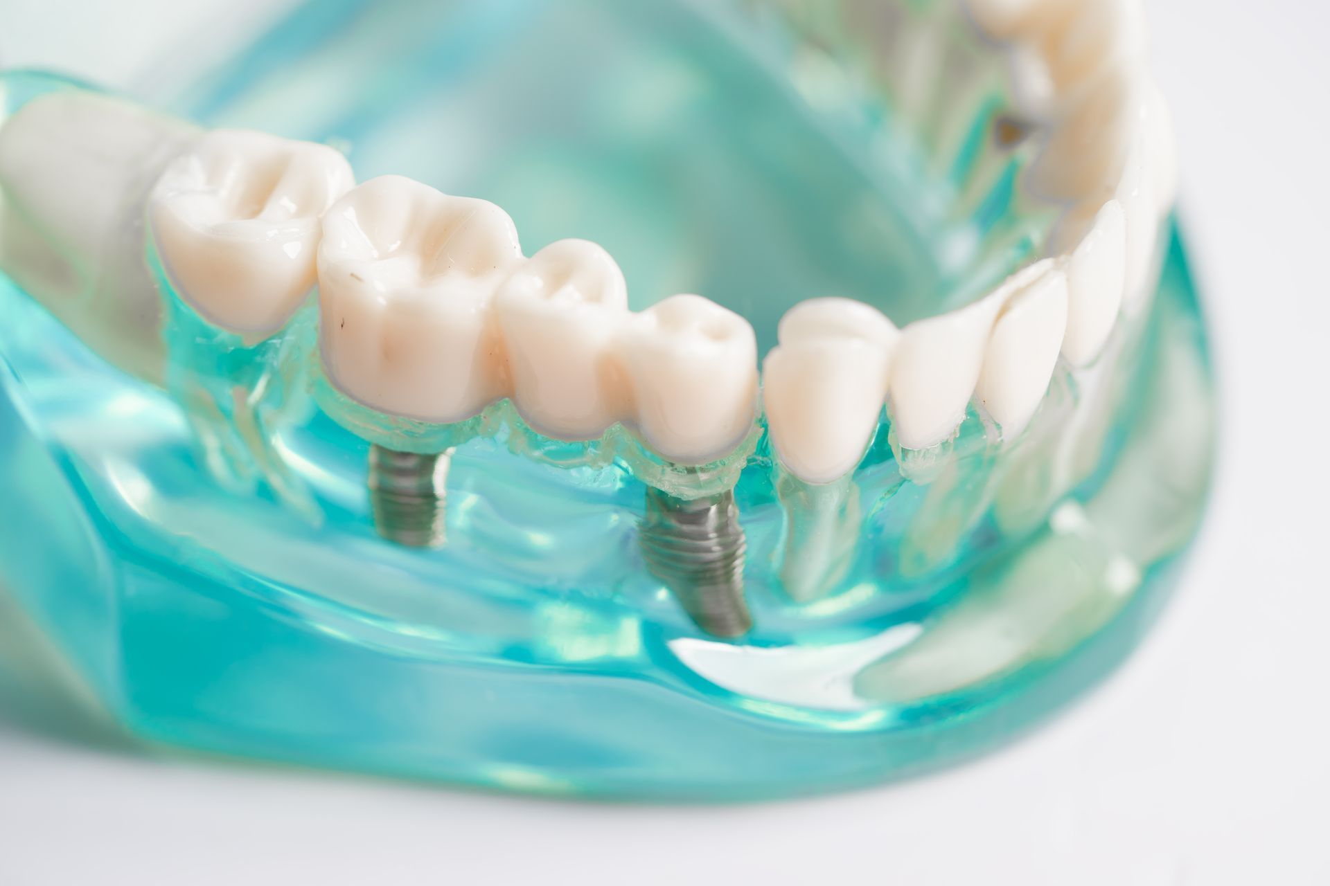 Dental model showing teeth with two implants in Corpus Christi, TX, 78404