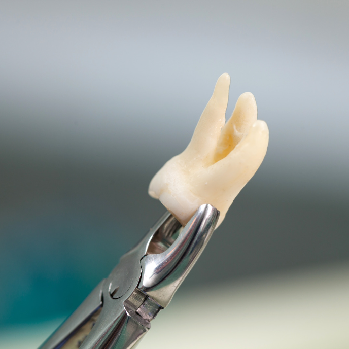 holding tooth after wisdom teeth extraction | Cosmetic and restorative dentist in Corpus Christi 78404