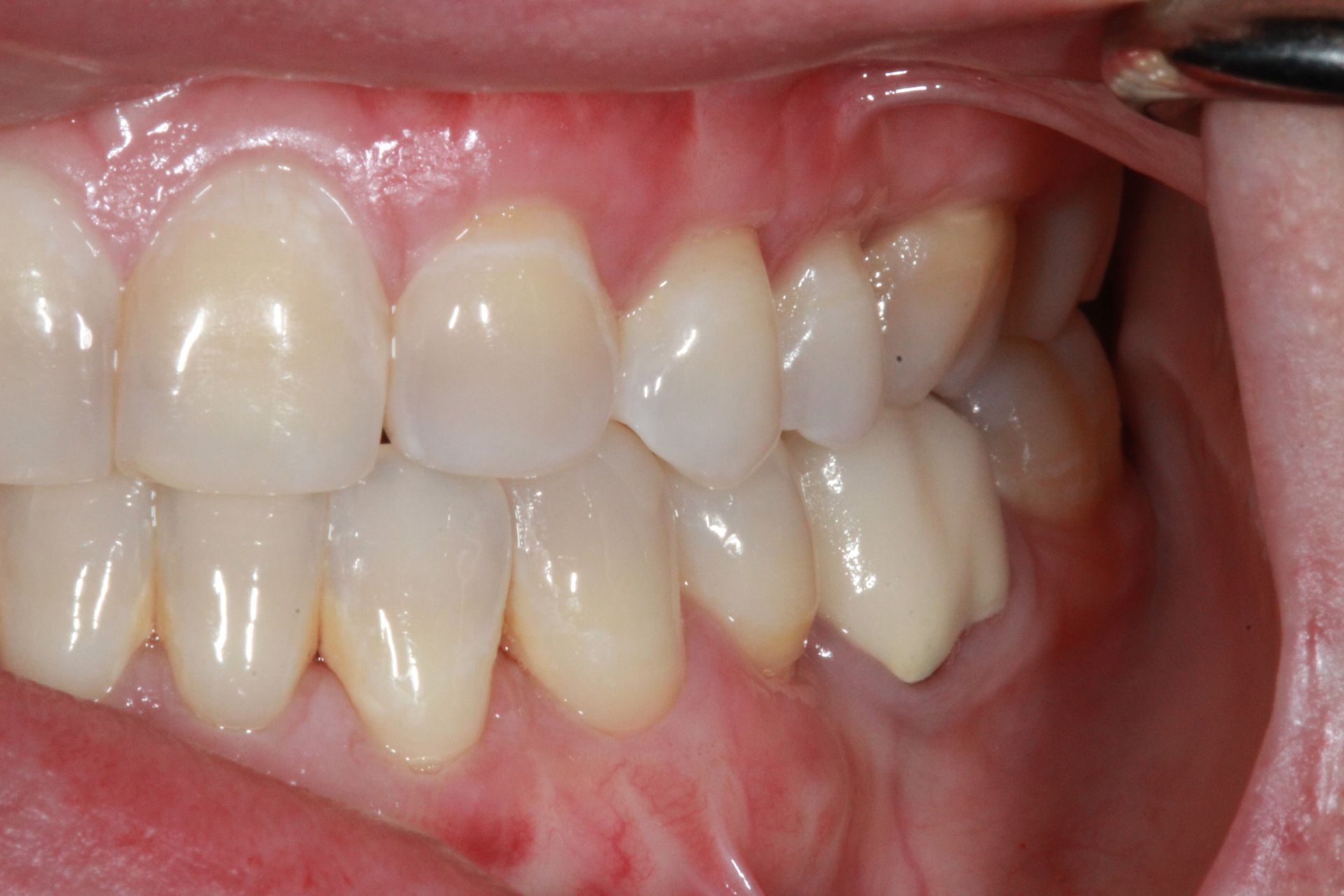 After Gum Grafting