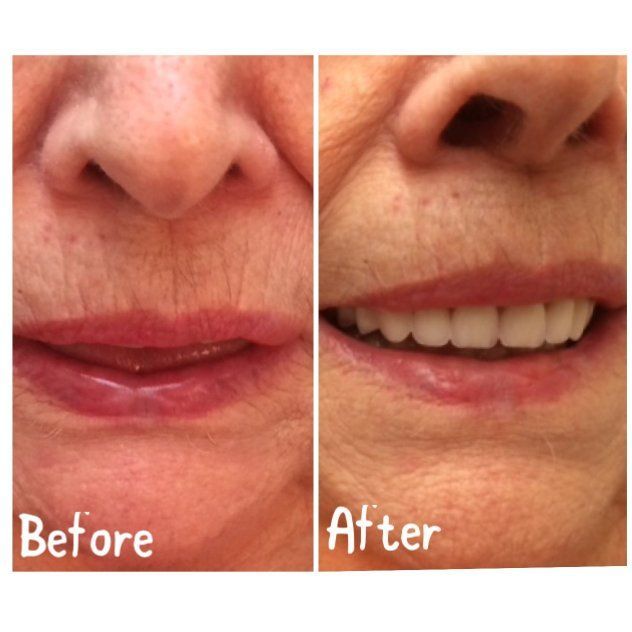 Side-by-side comparison of a person's mouth: before (collapsed lips) and after (full smile, visible teeth).