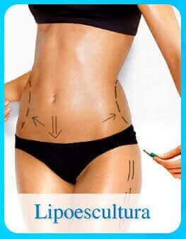 Lipoescultura