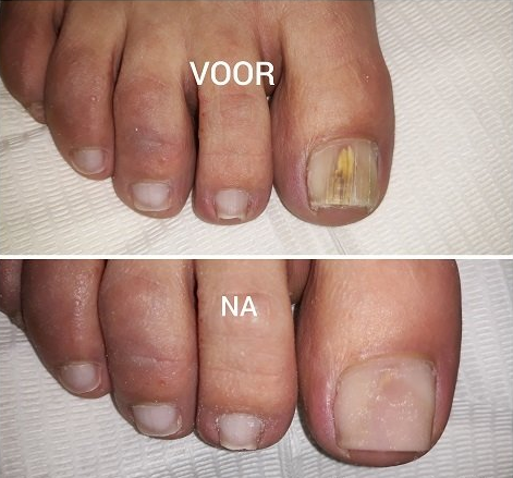 Voor- en nafoto's van een teennagel die behandeld is voor een schimmelinfectie.