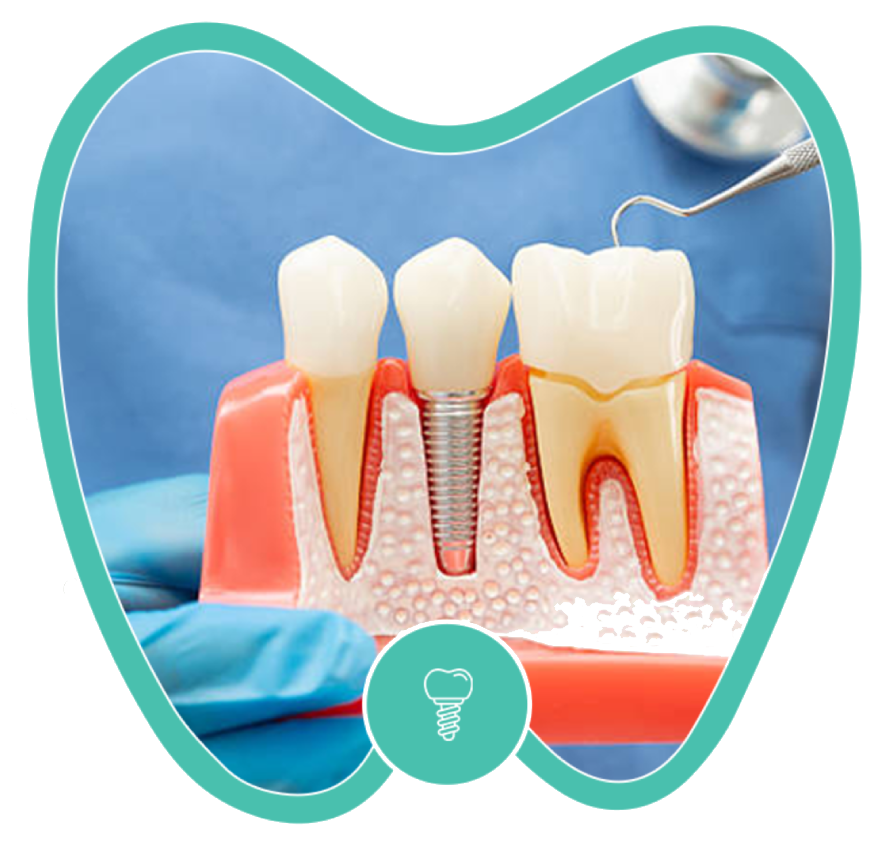 A model of a dental implant procedure with a clinician’s tool touching the crown of the third tooth.