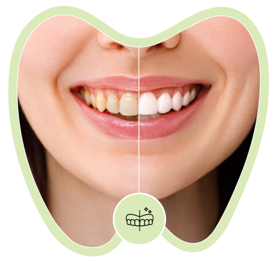 A close-up of a mouth showing a split comparison of yellowed teeth on the left and bright white teeth on the right.