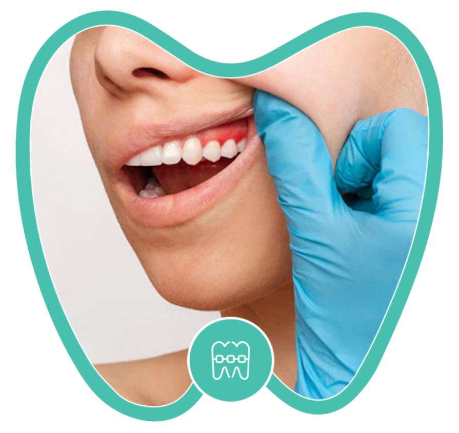 A person’s gum being gently pulled back by a gloved hand during a dental examination.