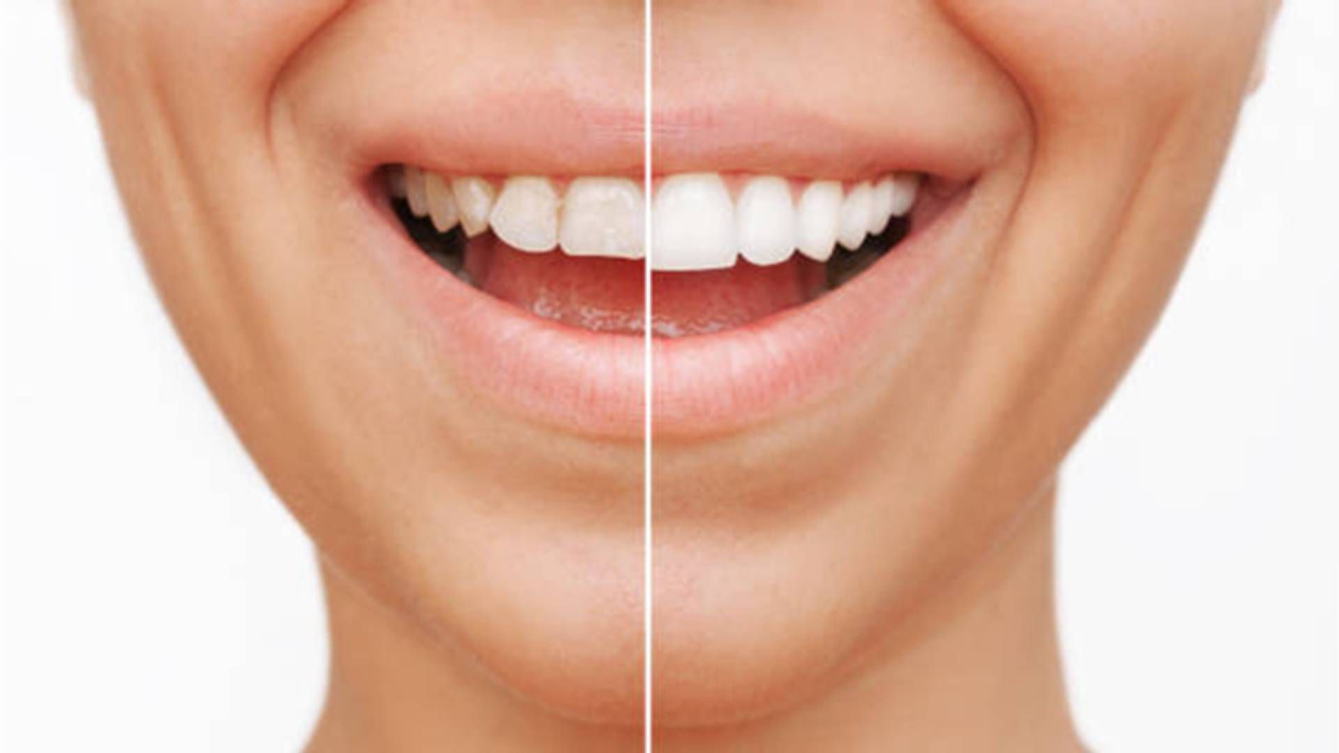 A close-up of a mouth showing a split-screen comparison of teeth before and after professional whitening treatment.