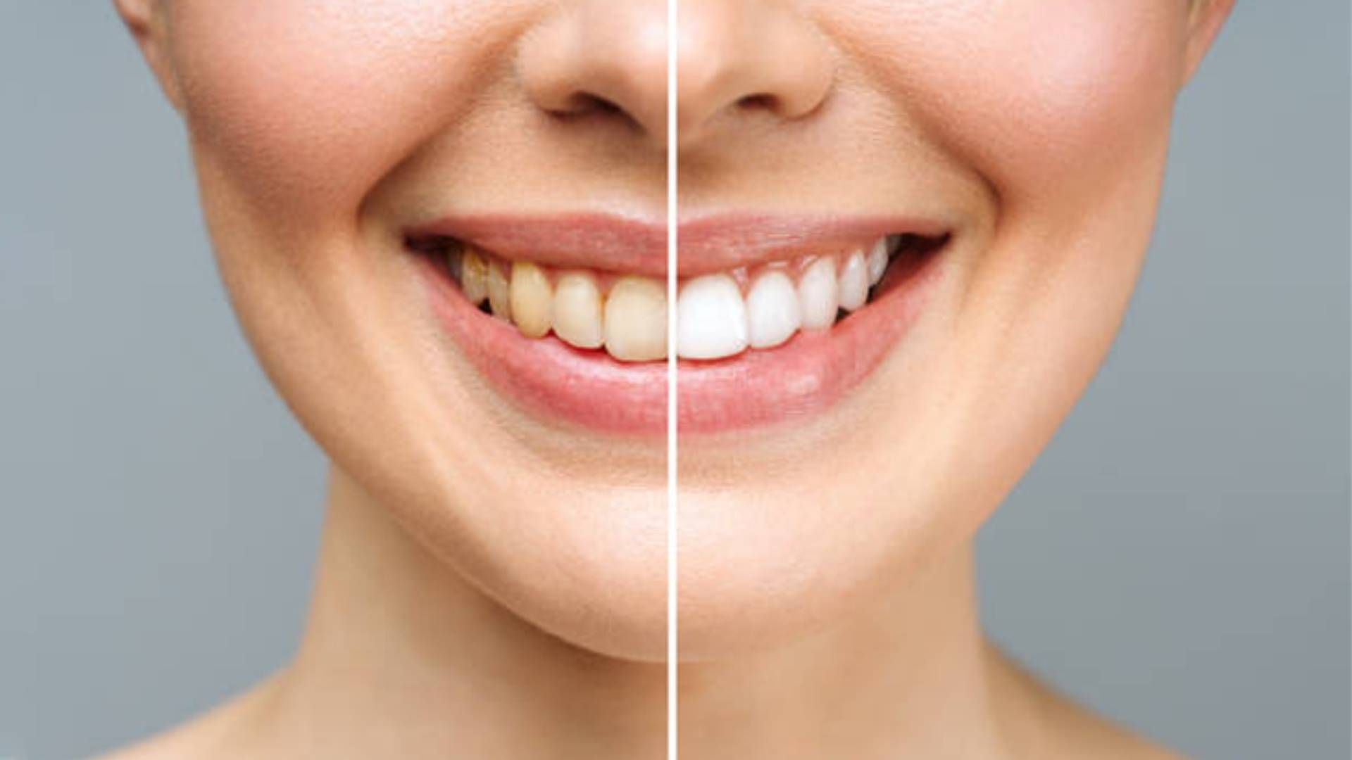 A split-screen comparison of a smile showing stained teeth on the left and whitened teeth on the right.
