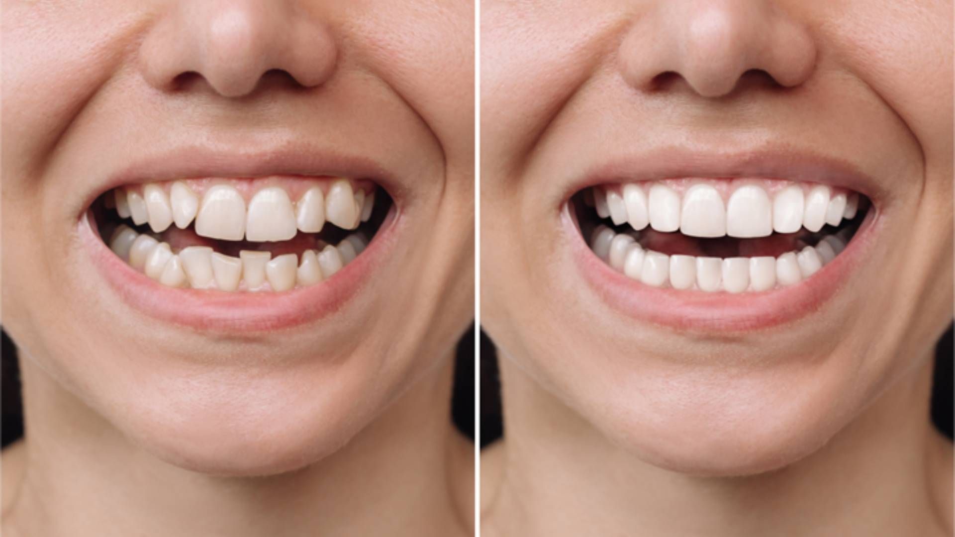 A split-screen comparison showing teeth before and after orthodontic treatment, displaying improved alignment.