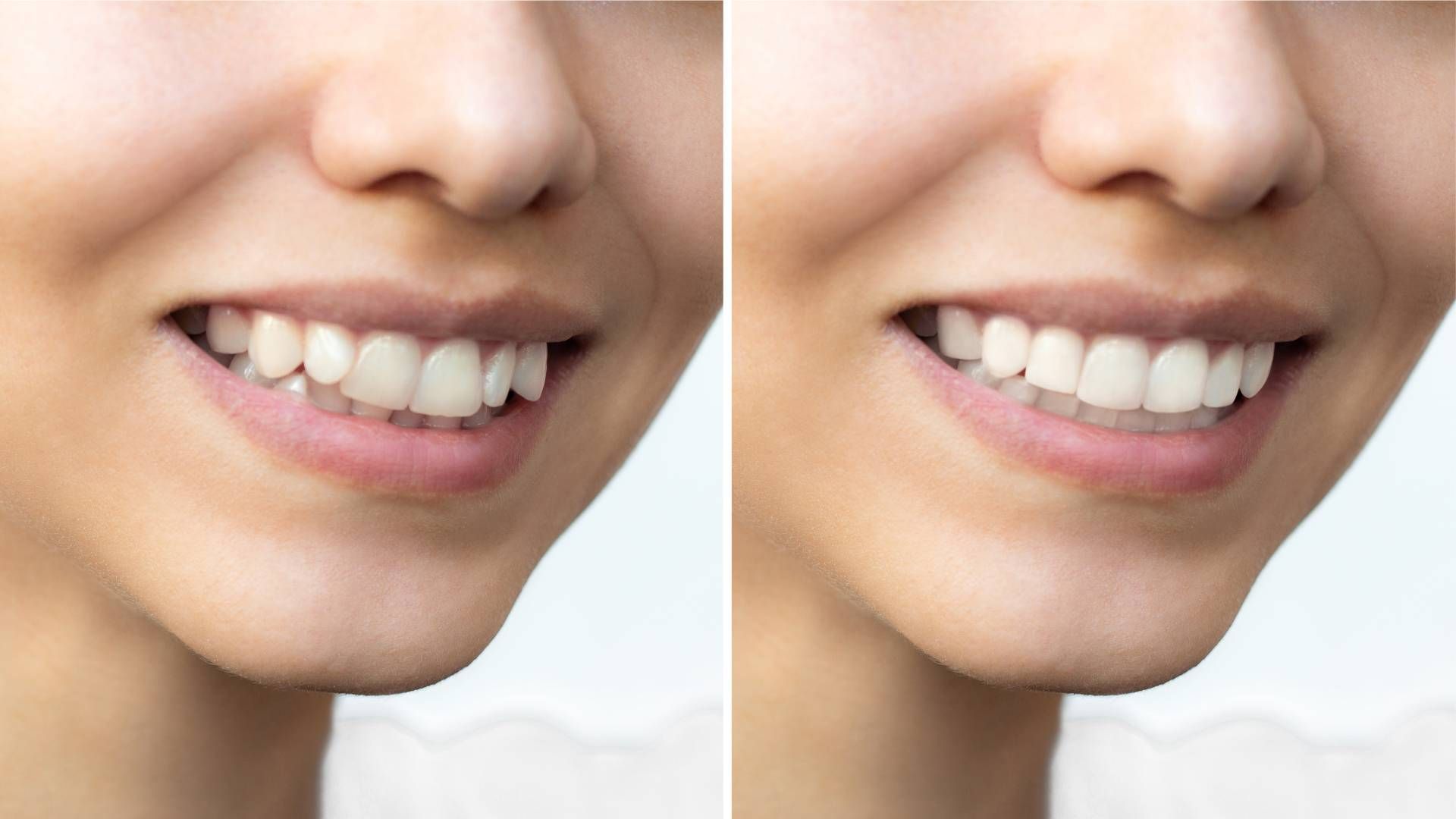 A comparison showing teeth before and after whitening, with the right side appearing brighter and whiter.
