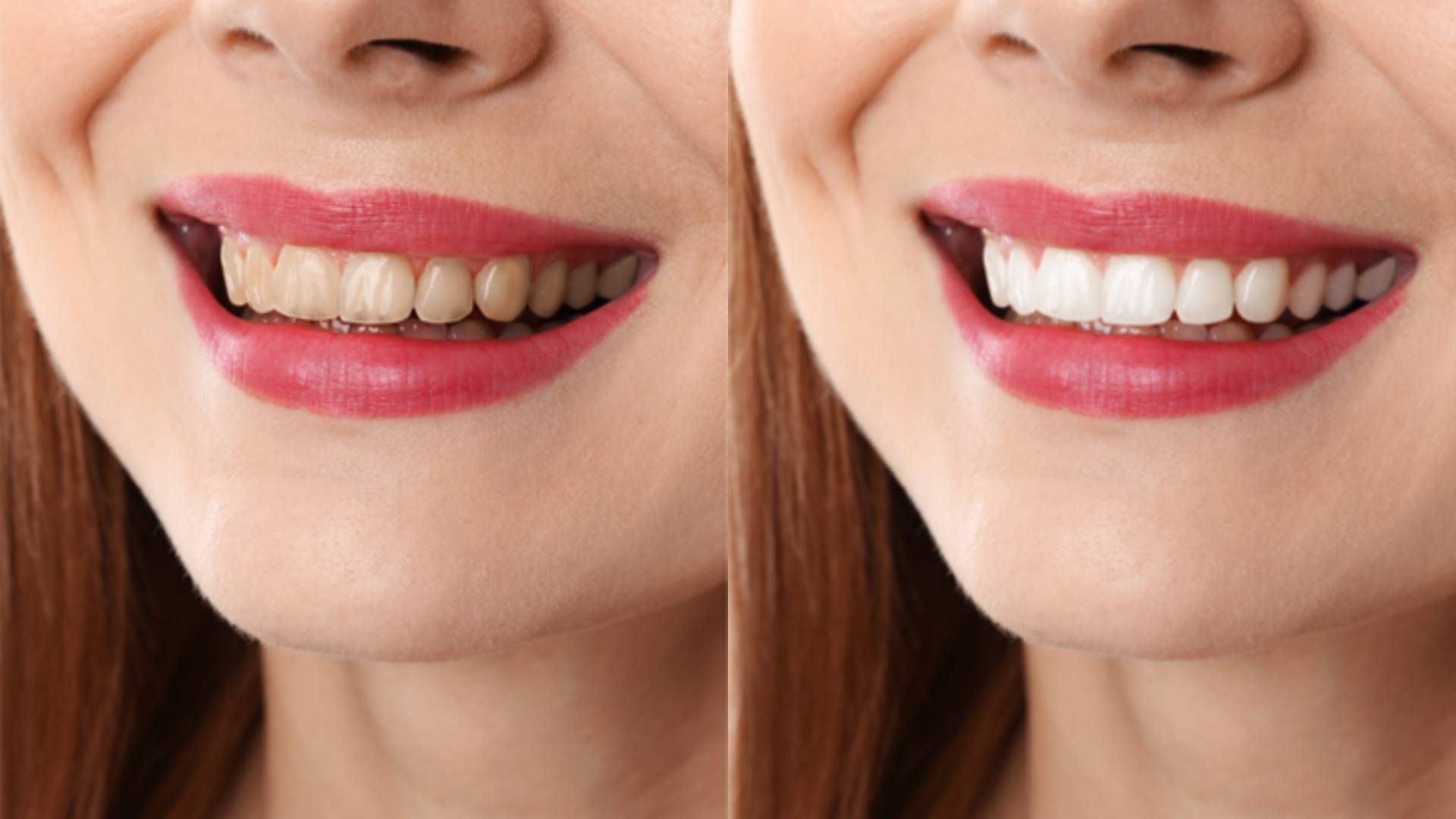 A split-screen comparison of a smile showing stained teeth on the left and bright white teeth on the right.