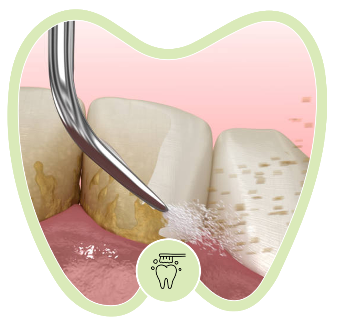 A dental tool sprays a fine mist onto teeth, removing yellow plaque near the gum line.