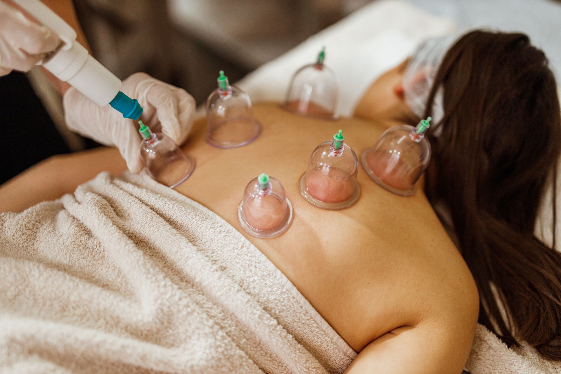 A woman is getting a cupping treatment on her back.