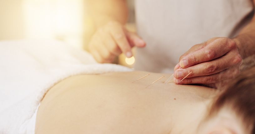 A woman is getting a acupuncture treatment on her back.