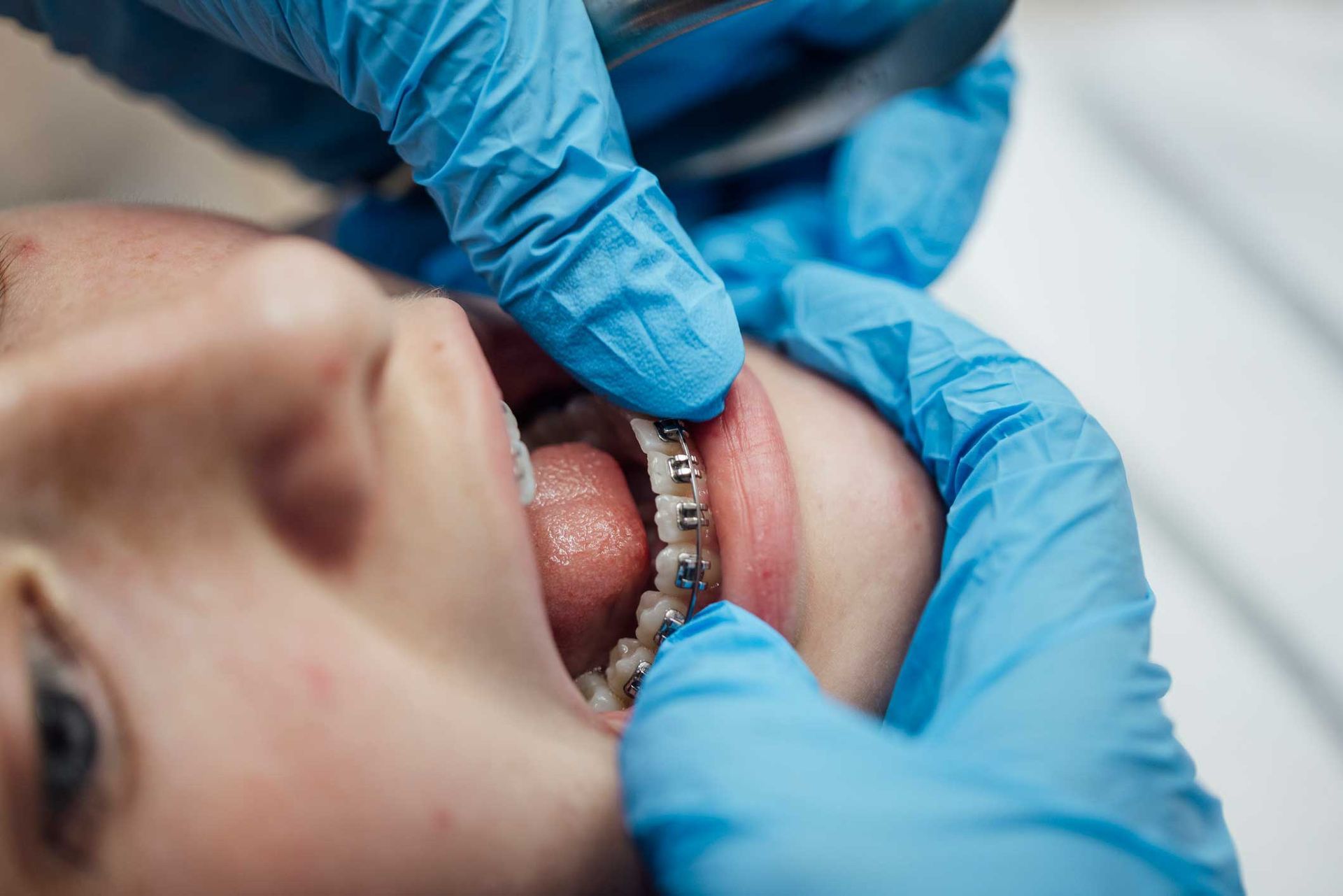 A young boy getting his teeth cleaned by a dental hygienist, showcasing positive orthodontic care.