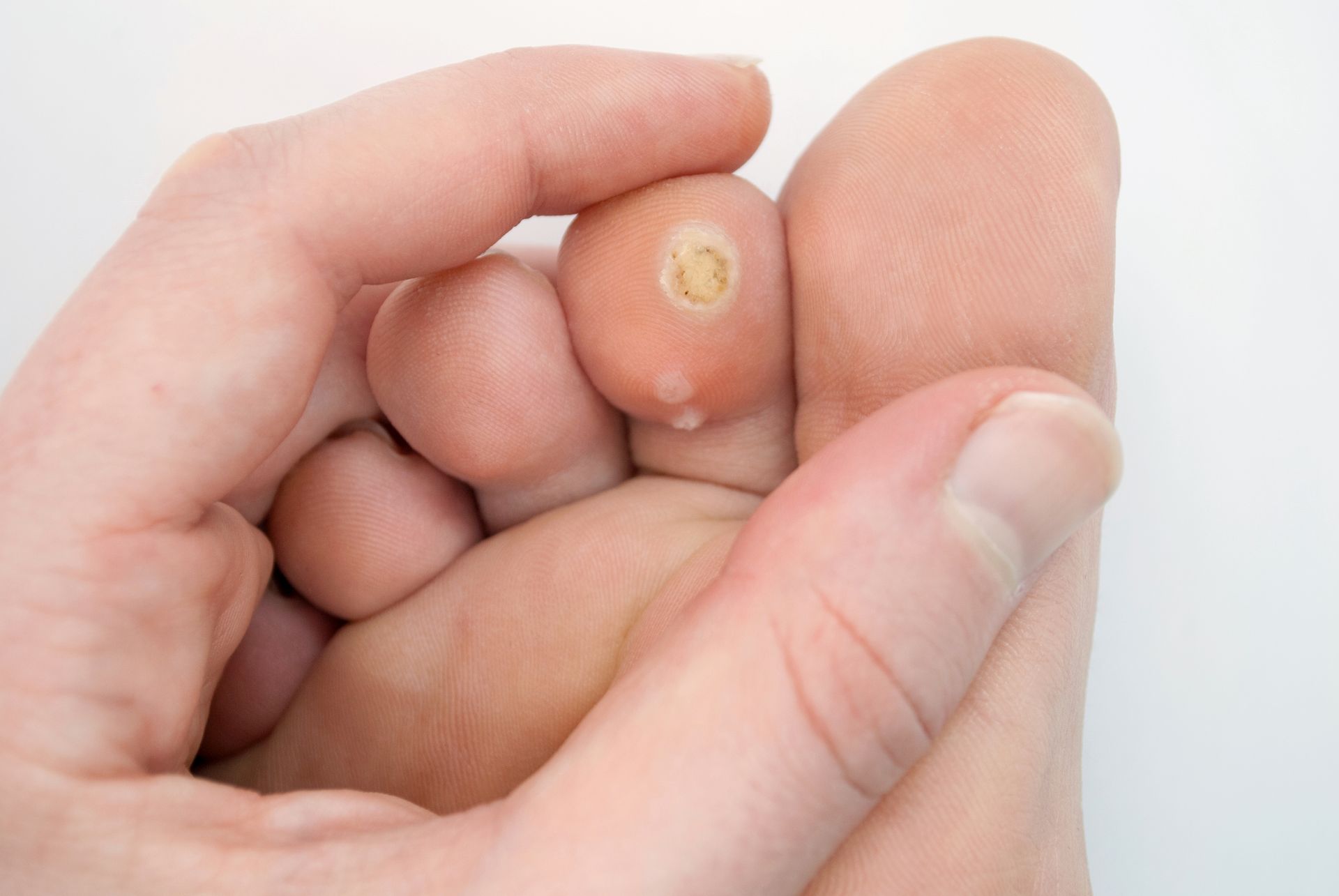 Hand holding a foot with a wart on the toe.