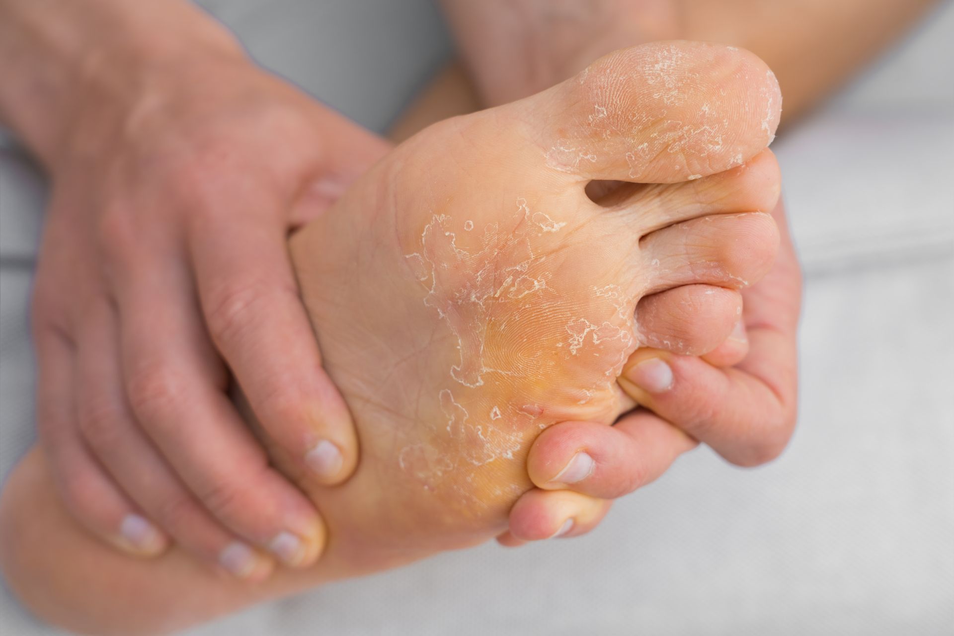 Person holding foot with flaky, dry skin on the sole and between toes.