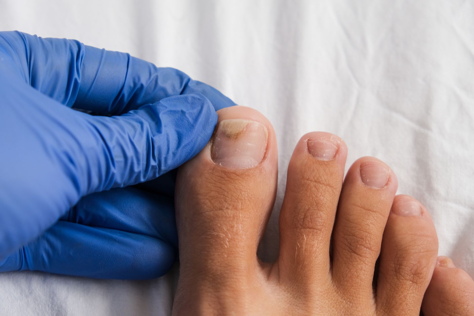 A person's foot with toenail fungus being examined by a gloved hand.