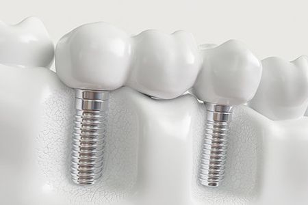 Implants With Dental Bridge — Man Getting His Teeth Checked in North Canton, OH