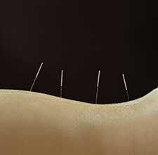 Accupuncture