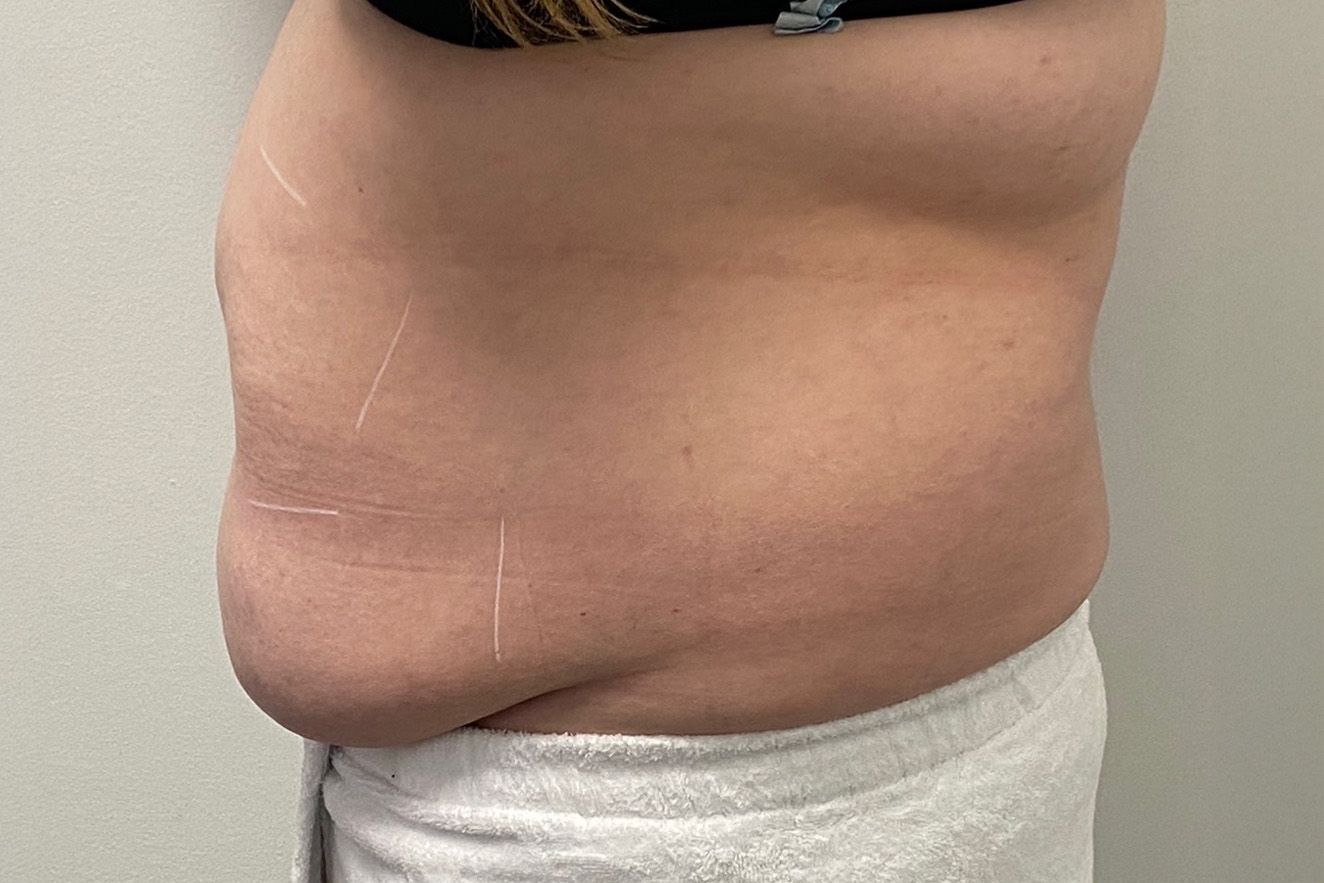 Side view of a person's abdomen with markings for a procedure for TruSculpt