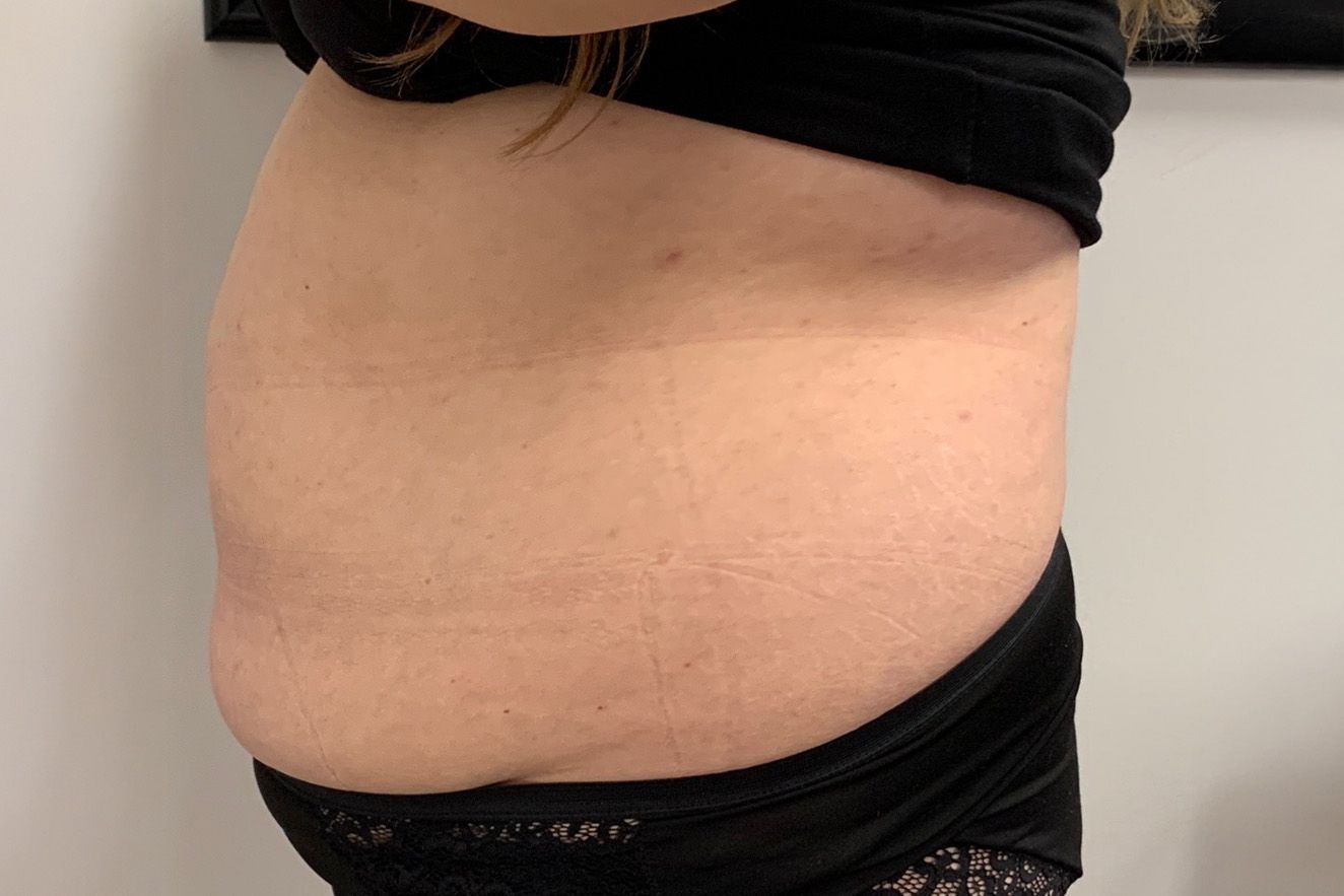 Side view of a person's stomach after TruSculpt Treatment