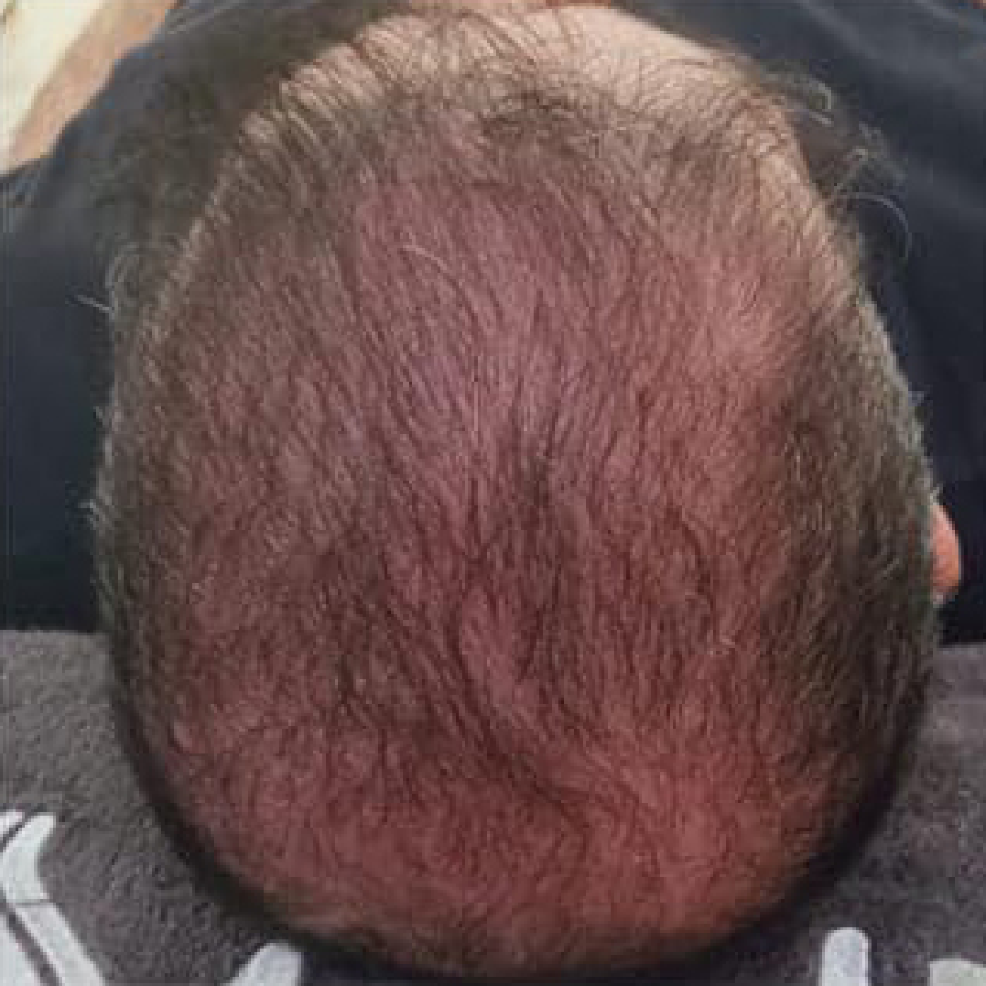 Der Hinterkopf eines Mannes mit viel Haar.