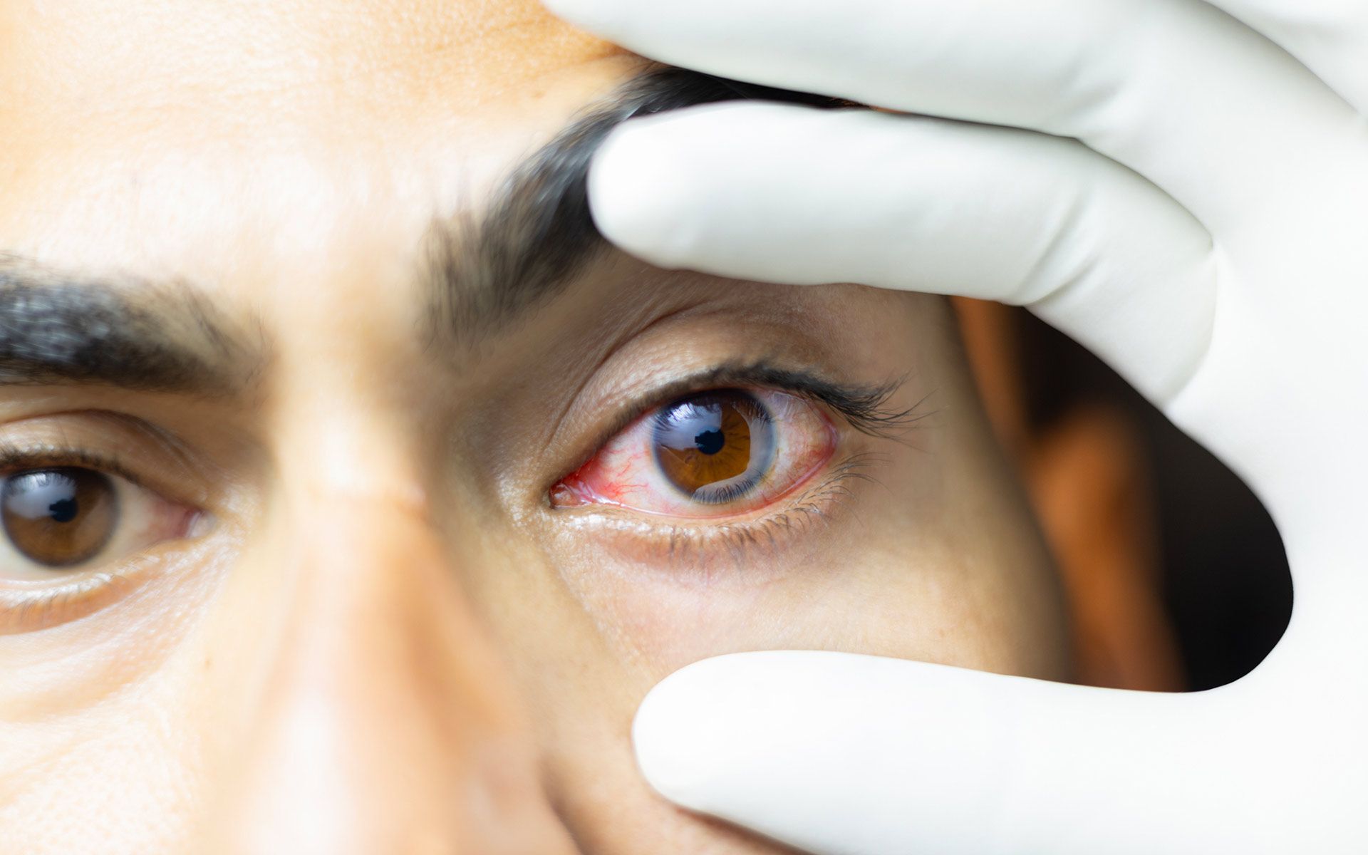 Eye Disease — Tyrone, GA — Williamson Eye Care - Tyrone