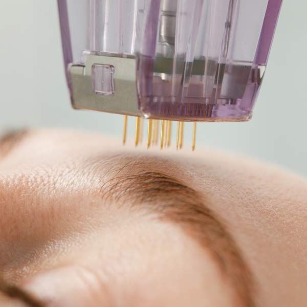 Woman receiving Collagen-Induction Acupuncture treatment